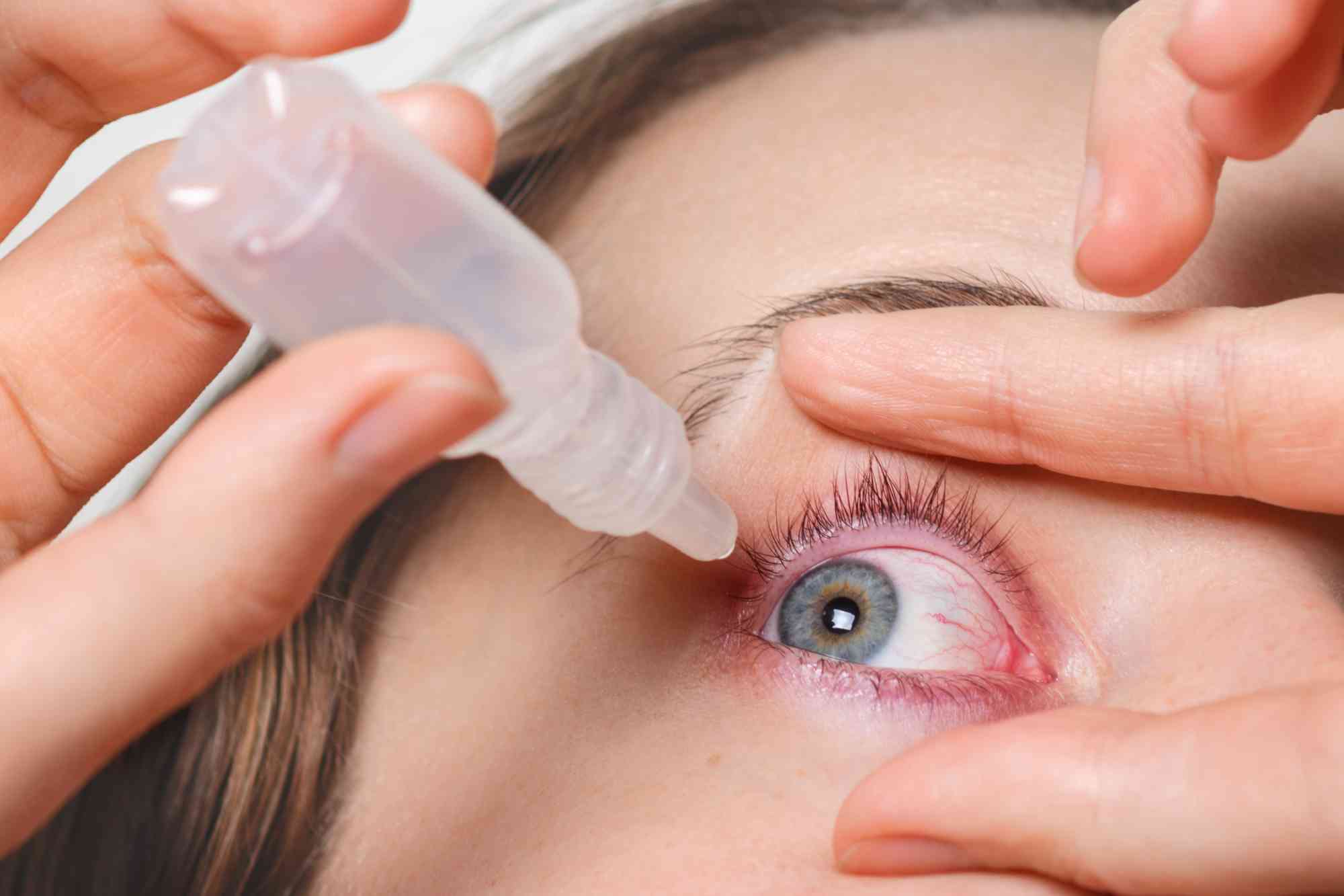 close-up-female-pours-drops-red-eye-has-conjuctivitis-glaucoma-bad-eyesight-pain-eyes-pain-treatment-concept-woman-cures-red-blood-eye (1) (1)